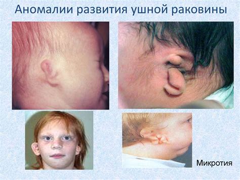 Аномалия развития уха
