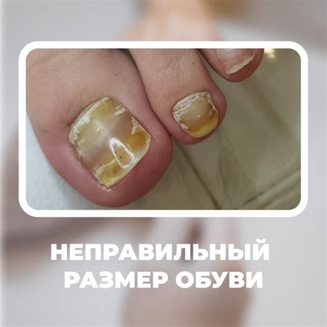 Влияние неподходящей обуви на посадку и работу ног