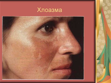 Заболевания и нарушения пигментации