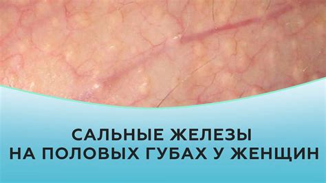 Нездоровый образ жизни и корочка на половых губах