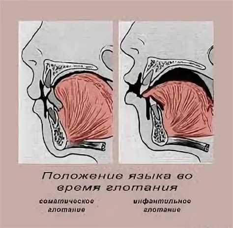 Неправильное положение языка