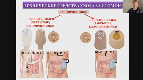 Неправильное уход за колостомой