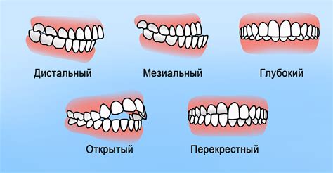 Неправильный прикус