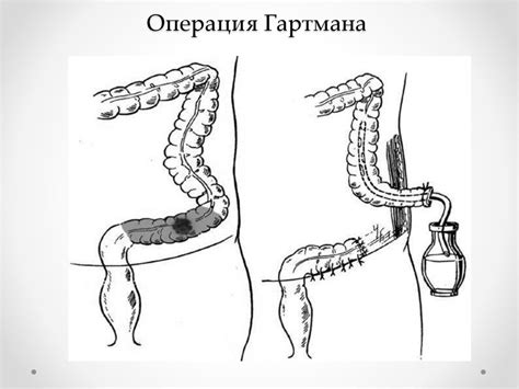 Операция по установлению колостомы