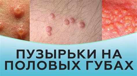 Основные симптомы корочки на половых губах