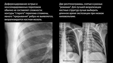Повреждение ребер зонта