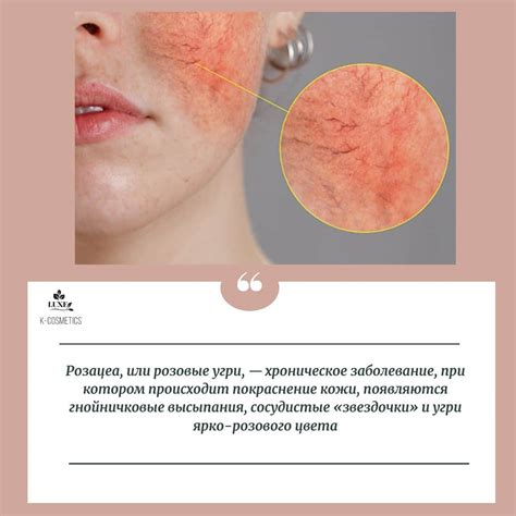 Повышенная чувствительность к кожным раздражителям