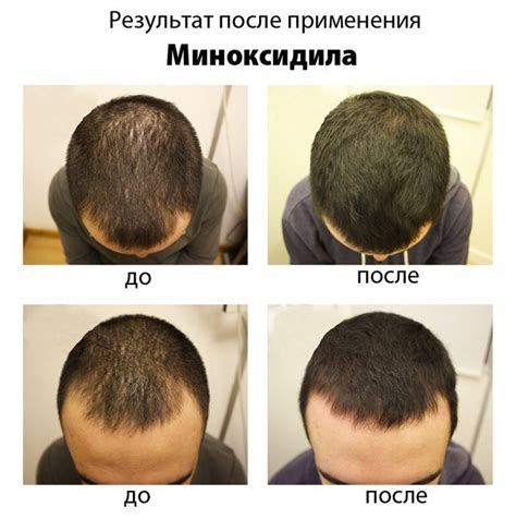 Природные причины роста волос на анусе у мужчин