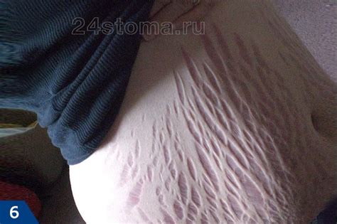 Причины чешущихся растяжек на животе после родов