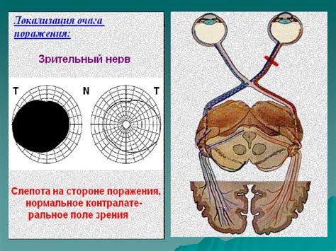 Проявление резкого изменения зрительной функции