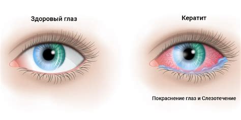 Связь между белым пятном в глазу и нарушением функции зрения