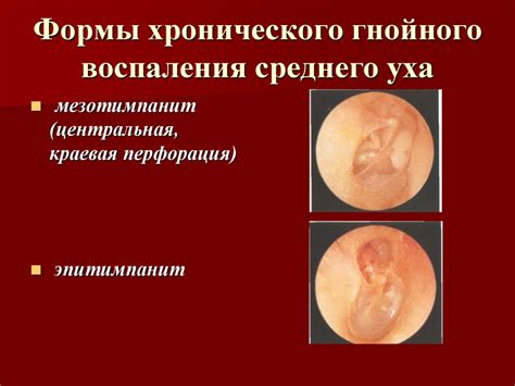 Хроническое воспаление уха