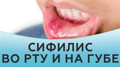 Эффект проявления горчинки во рту